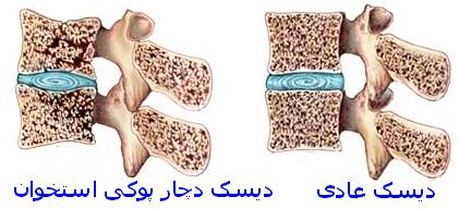 تشخیص پوکی استخوان